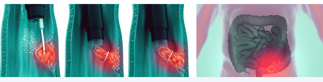 medicos-quirofano-hacen-laparoscopia